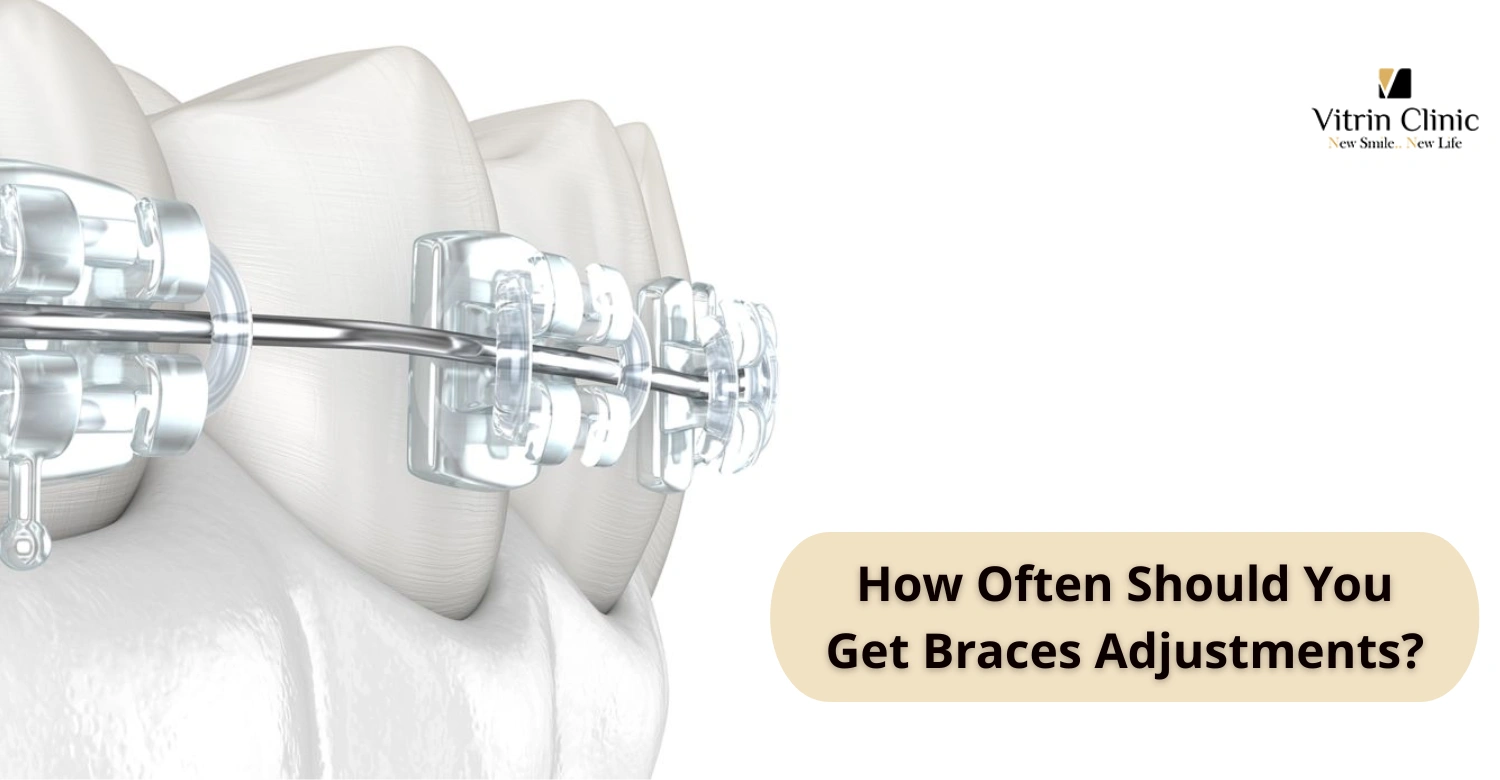 Wie oft sollte man die Zahnspange nachstellen lassen?